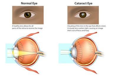 Advancements In Cataract Surgery Technology