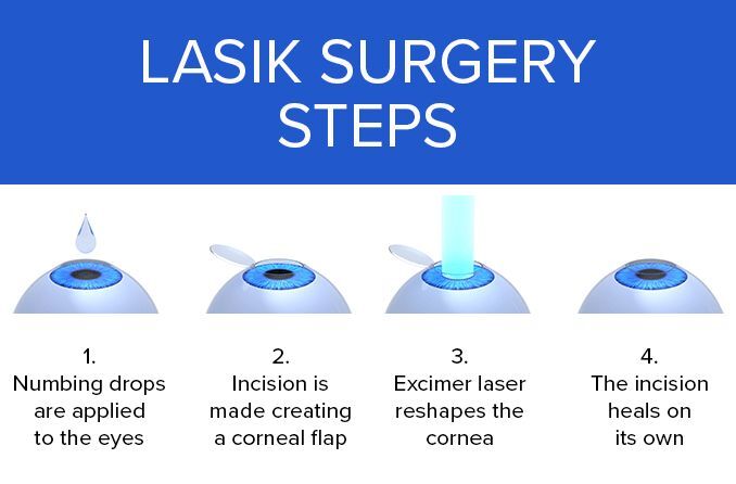 Life After LASIK: Maintaining Your New Vision