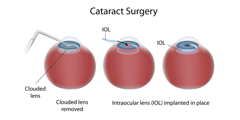 Cataract Surgery: A Comprehensive Guide