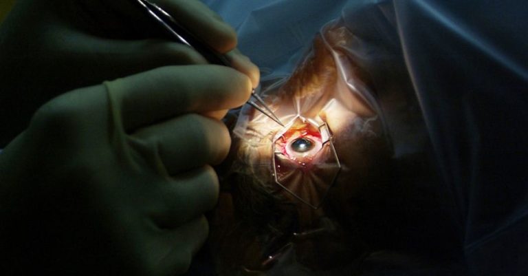 Understanding Previous Eye Surgery: Types and Outcomes